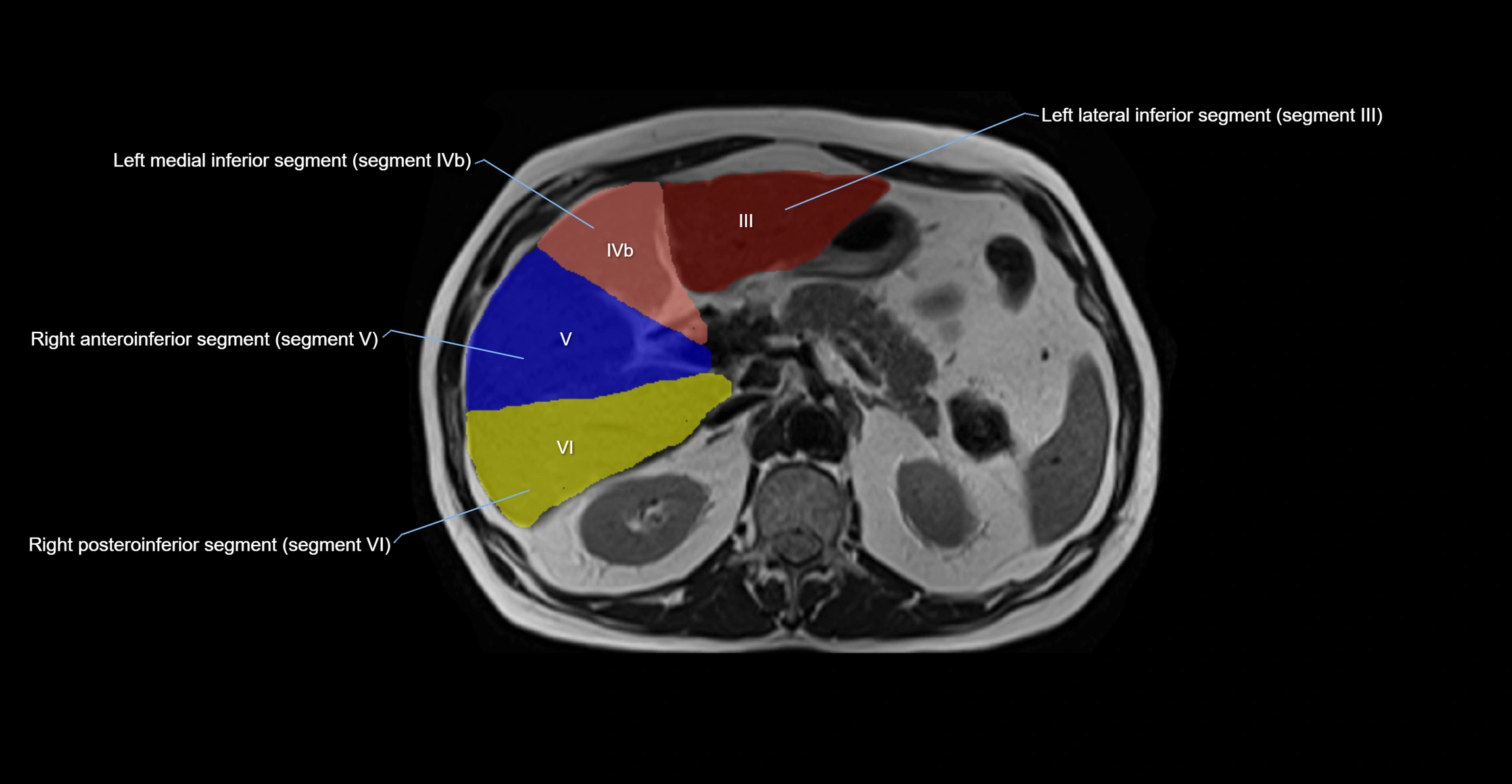 MRI  liver segments anatomy axial cross sectional 3T radiology  image-img-00001-00016.webp